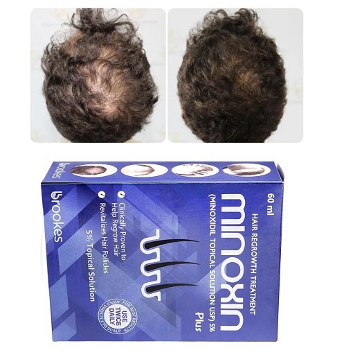 Minoxin Hair Topical Solution Minoxin Hair Topical Solution